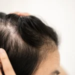 types of hair loss explained at The Cutting Room