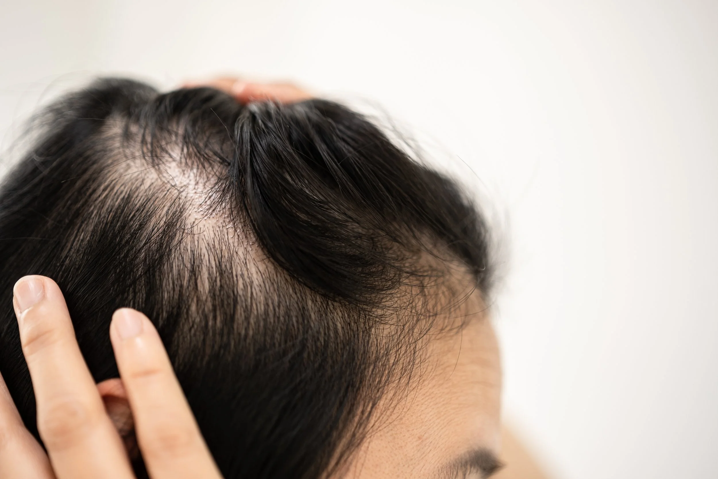 Understanding Hair loss- different types, causes and treatments